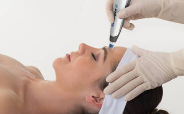 Wat is microneedling?