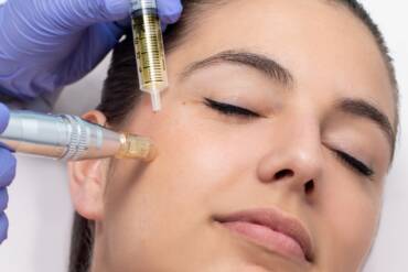 Wat doet microneedling voor je huid?